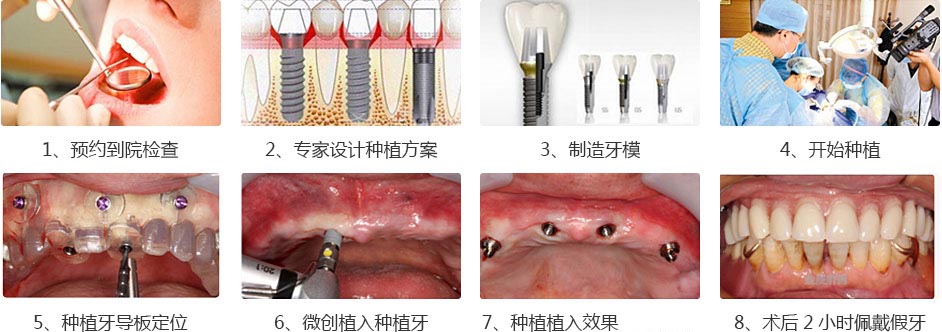专家详解多颗种植牙的过程